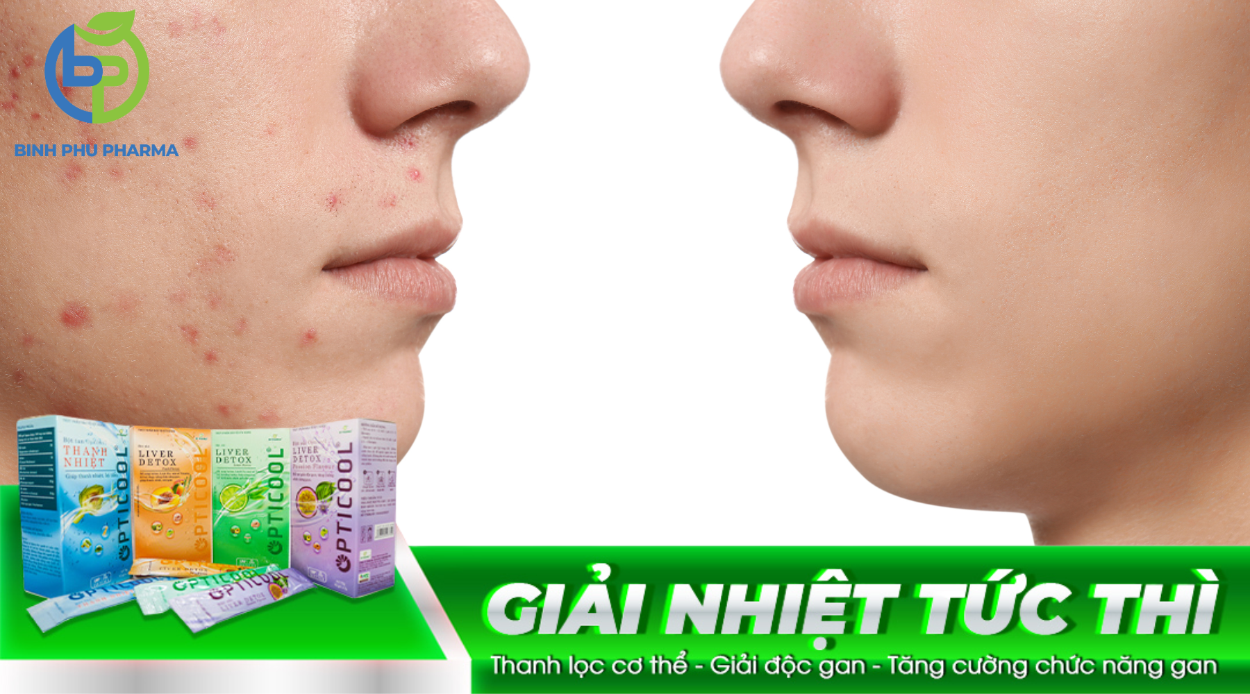Feature image for post: MỤN NHỌT GÂY THIẾU TỰ TIN ĐÓN HÈ
